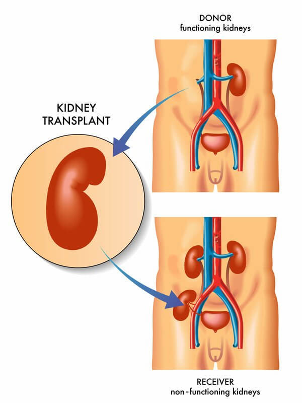 Kidney Transplation Process